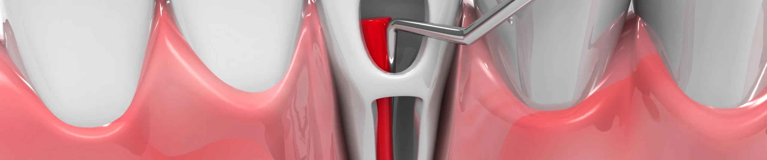 Endodontie : traitements au cabinet dentaire des Drs Serror de Marolles en Hurepoix (91630)