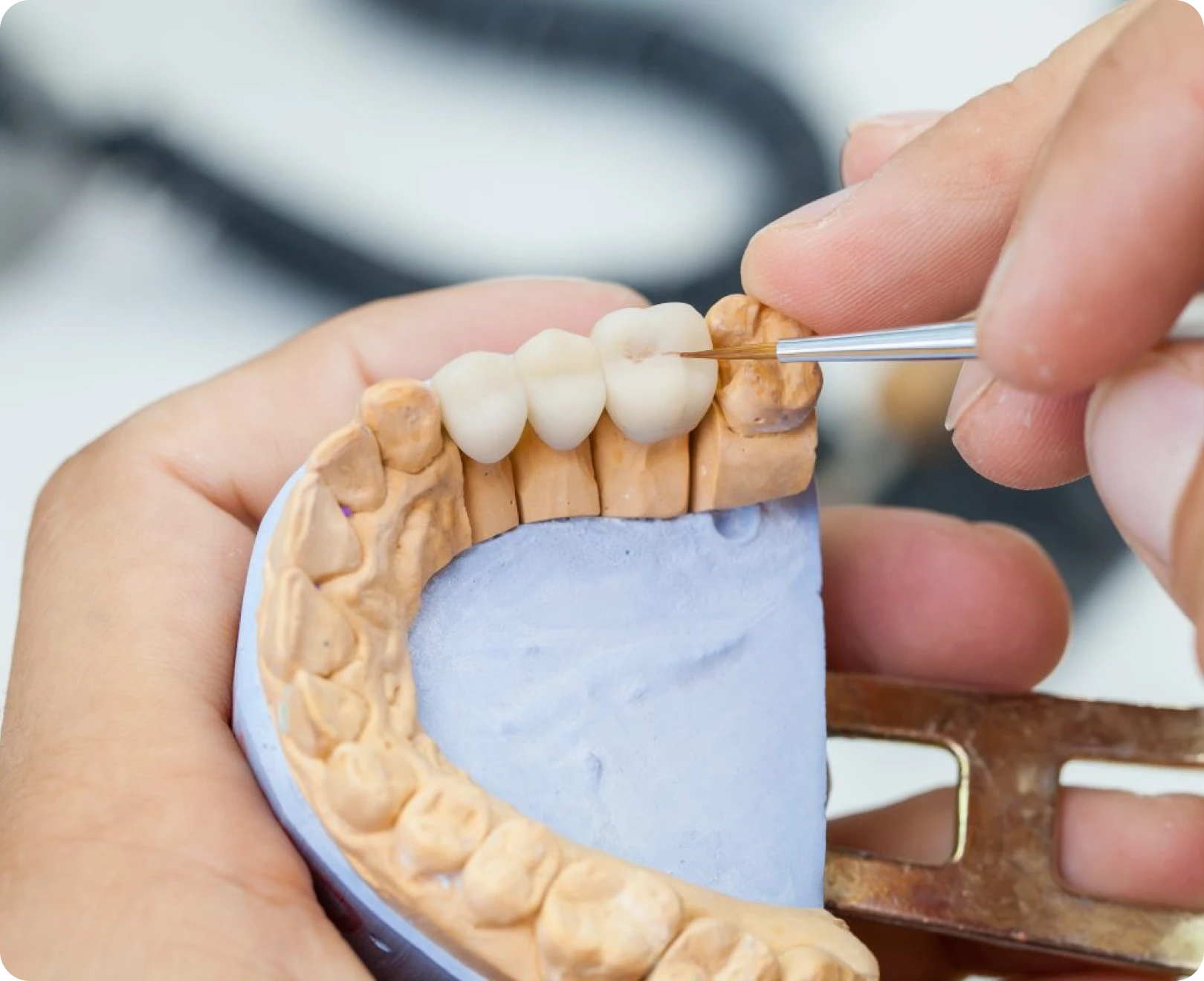 Soins prothétiques au cabinet dentaire de Marolles en Hurepoix (91630)
