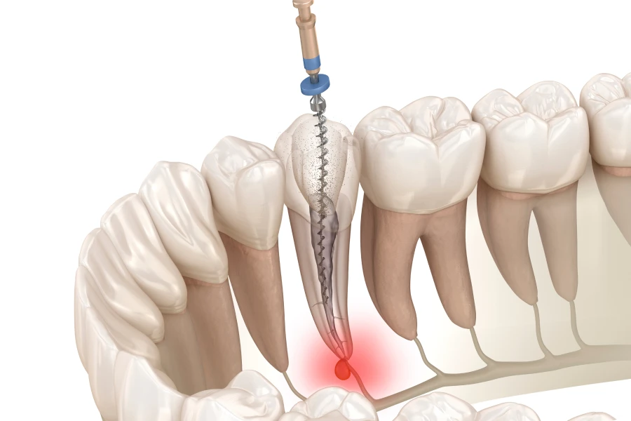 Traitements endodontiques au cabinet dentaire de Marolles en Hurepoix (91630)