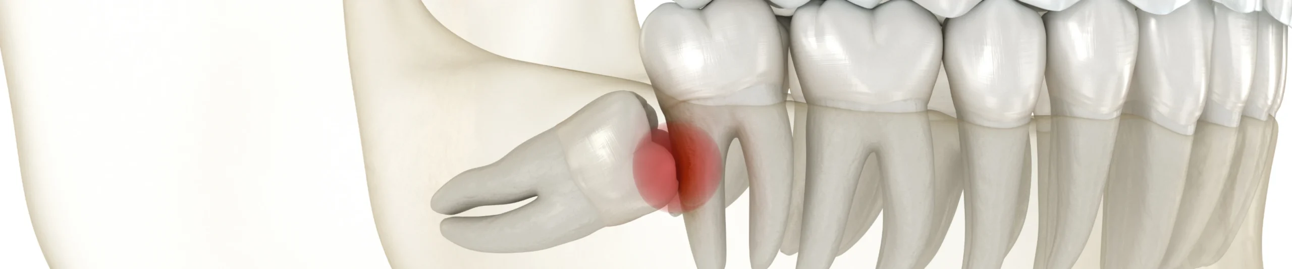Après une extraction dentaire : conseils du cabinet dentaire des Drs Serror de Marolles en Hurepoix (91630)