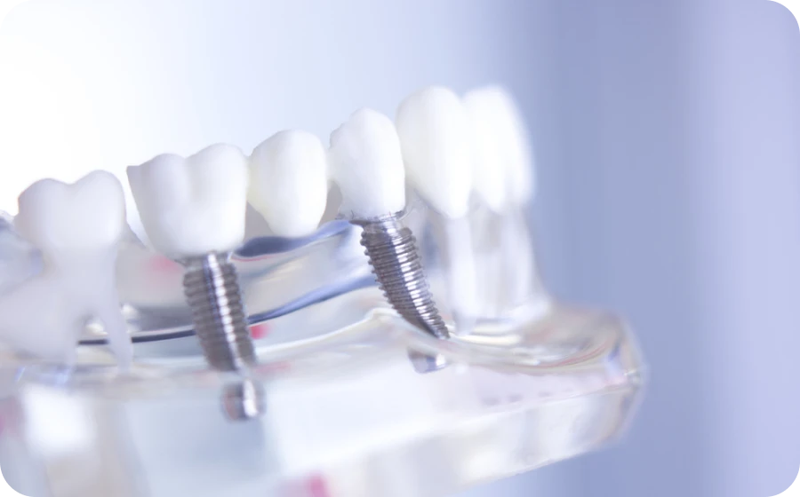 Le bridge dentaire au cabinet dentaire des Drs Serror de Marolles en Hurepoix (91630)