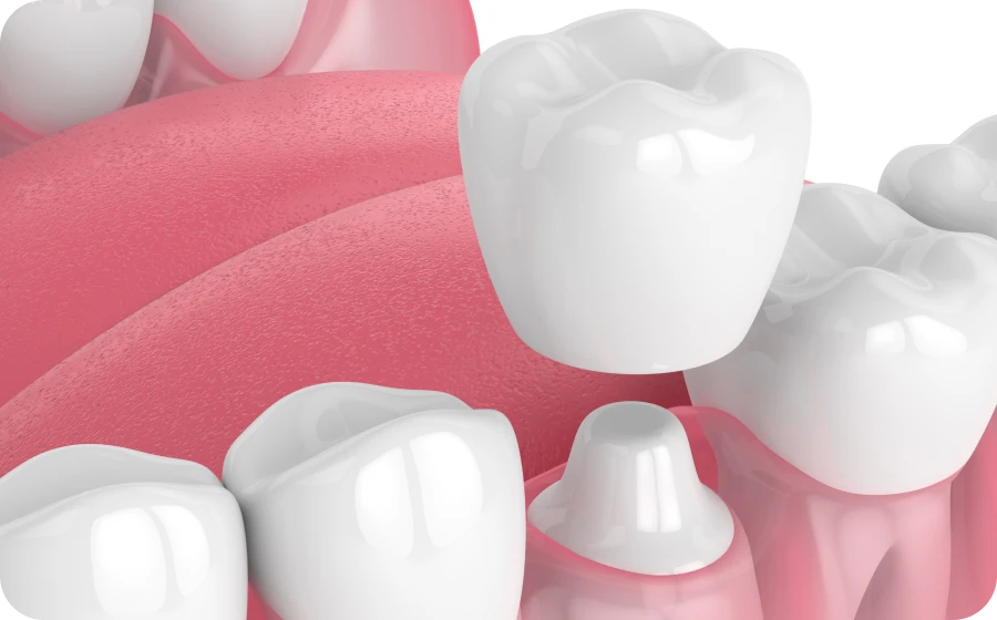 Les couronnes dentaires au cabinet dentaire de Marolles en Hurepoix (91630)