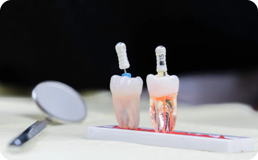 La dévitalisation dentaire au cabinet dentaire des Drs Serror de Marolles en Hurepoix