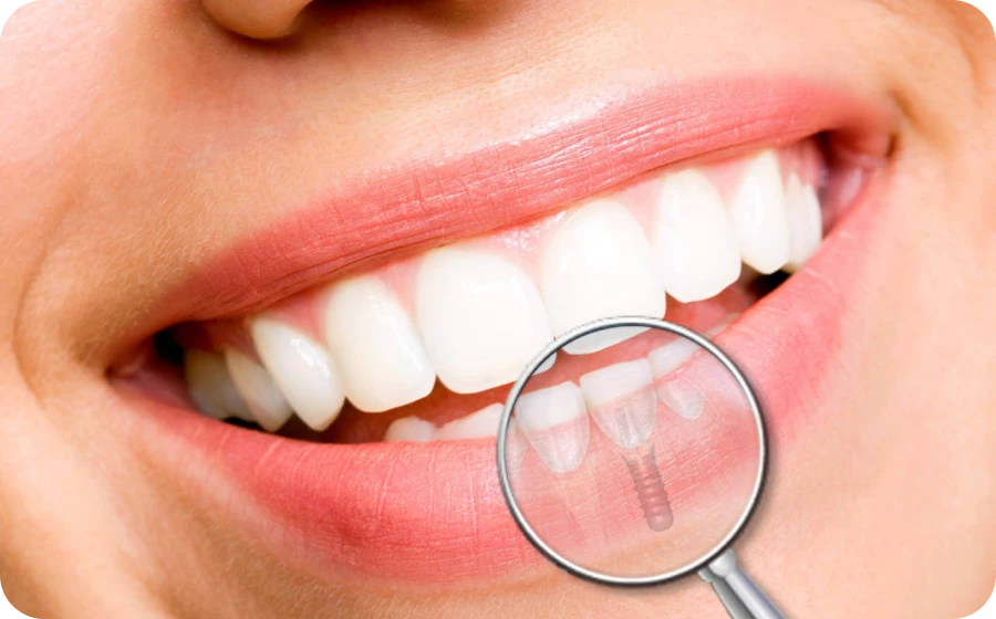 La pose d’un implant dentaire au cabinet dentaire des Drs Serror à Marolles en Hurepoix (91630)