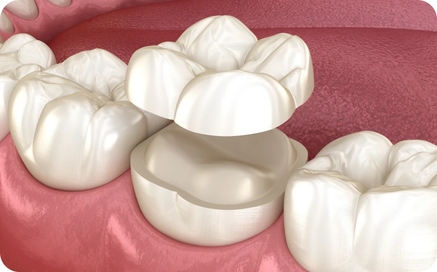 Les onlays au cabinet dentaire de Marolles en Hurepoix (91630)